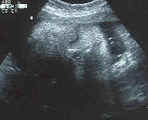 Cambren's ultrasound 12/99